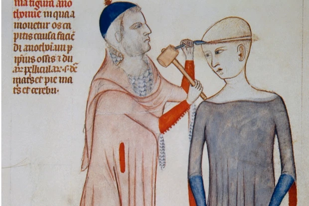 trepanning